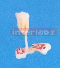 SMALL CARIES MOLAR, 2 PCS/SET